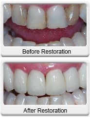 Chandler Cosmetic Dentist - All Ceramic Crowns - antes e depois