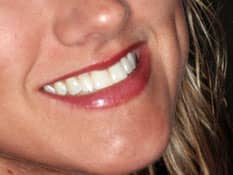 Chandler Cosmetic Dentist - All Ceramic Crowns Dental Restoration