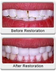 dental bonding veneering before after