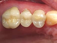 dental composites after tooth colored fillings restoration