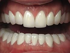 dental crowns veneers after