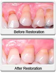 dental gum grafting before after