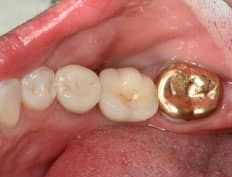 dental implant after placement with crown