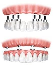 dental implant retained denture with all on 4