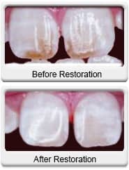 dental re-contouring before after