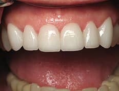 dental veneers after