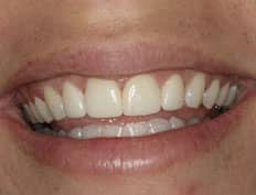 dental veneers after