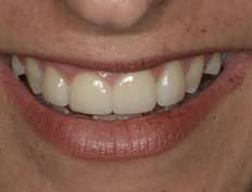 dental veneers after