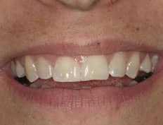 dental veneers before