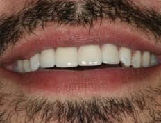 dental veneers after