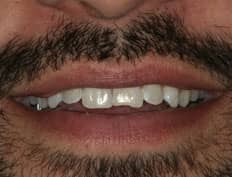 dental veneers before