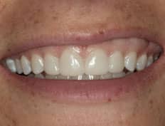 dental veneers after