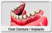 Over Denture from Ocotillo Dental Care in Chandler, AZ