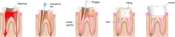 Chandler Dentist - root canal cross section illustration