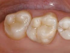 Tooth Colored White Fillings restored after amalgam removal